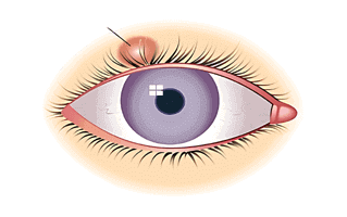 Chalazion Photos